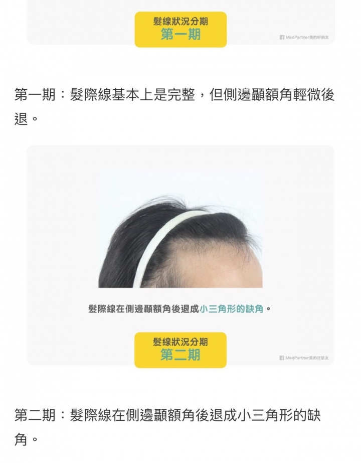 本身高額頭 細 少髮該如何拯救