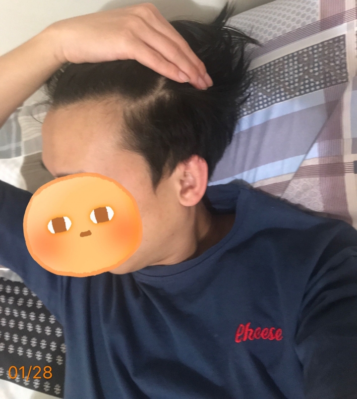 本身高額頭 細 少髮該如何拯救