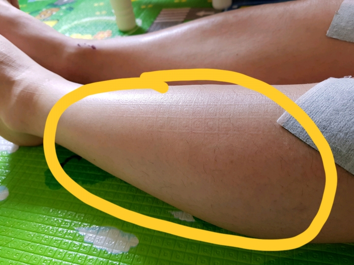跑步過程左腳小腿腫像抽筋感覺