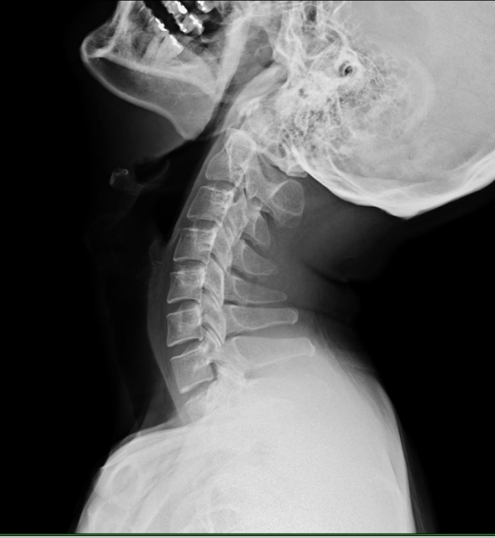 背部雙手痠麻，文有X光及MRI，始終好不了...