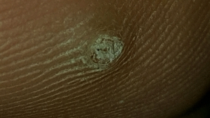 病毒疣還是雞眼 有圖慎入