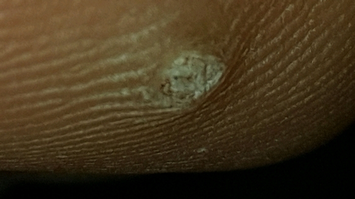 病毒疣還是雞眼 有圖慎入
