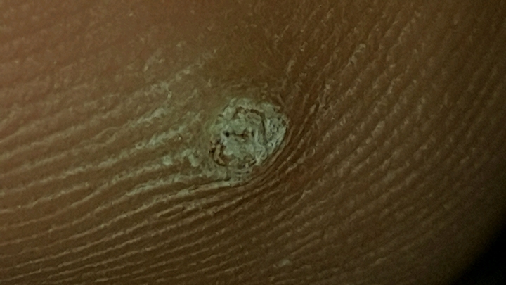 病毒疣還是雞眼 有圖慎入
