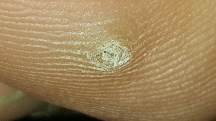 病毒疣還是雞眼 有圖慎入