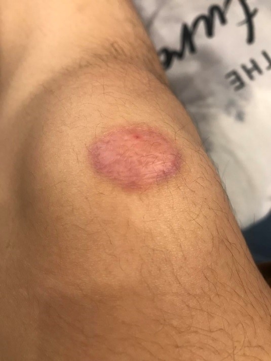 車禍蟹足腫除疤