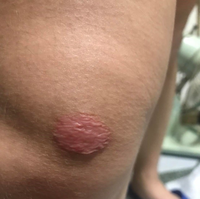 車禍蟹足腫除疤