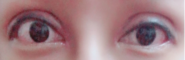 血淚割雙眼皮痛苦⋯⋯