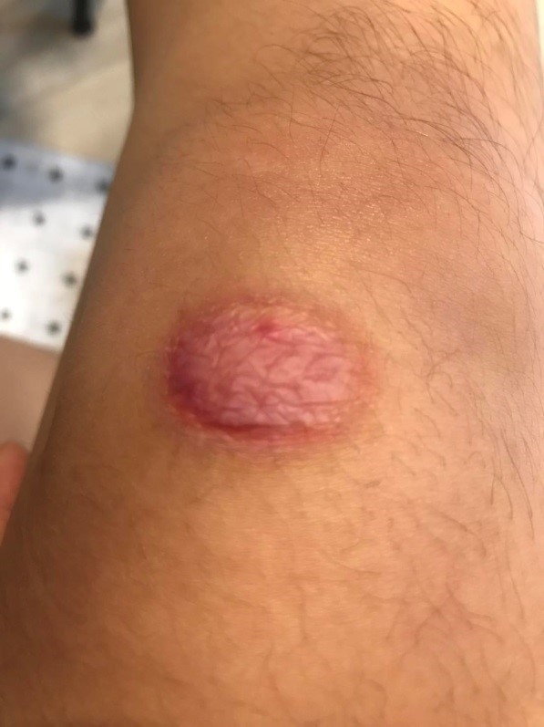 車禍蟹足腫除疤