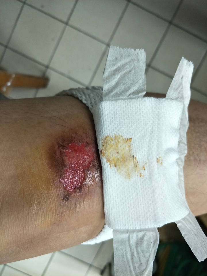 車禍傷口復原情況