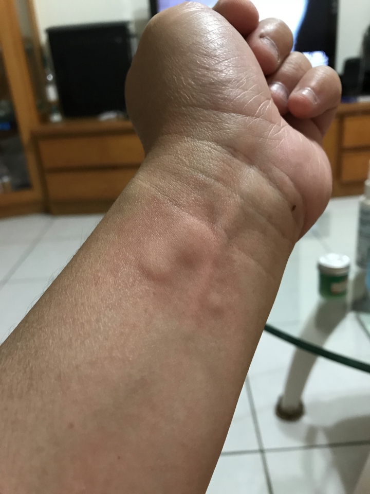 蕁麻疹的辛酸史