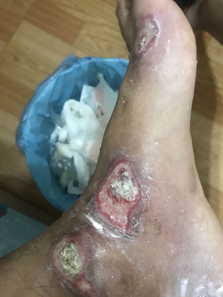 雷殘腳受傷—-已到知名龍昌換藥