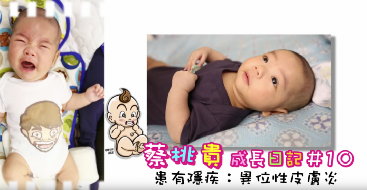家中也有異膚寶寶嗎?