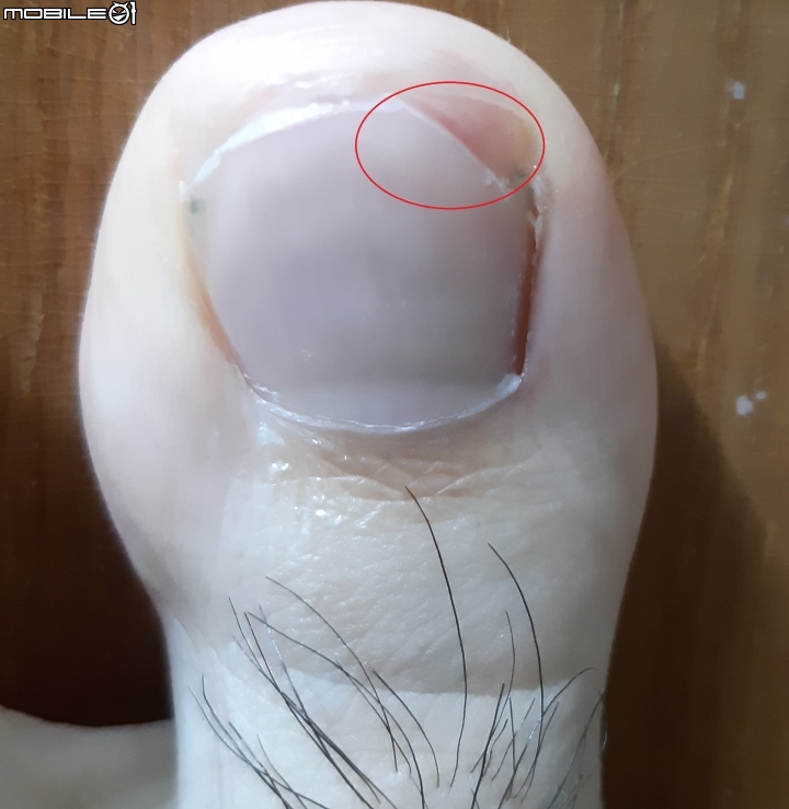 腳指甲剪太短 肉會痛 該如何處理?