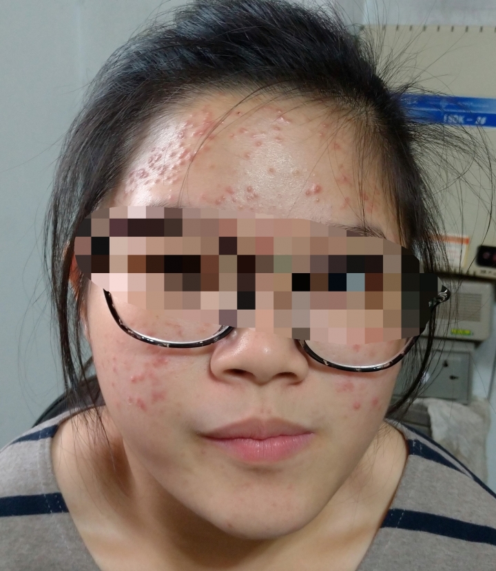 姪女臉上長滿痘痘，該去哪看醫師？