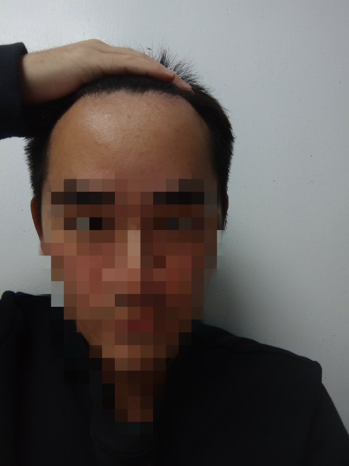 這樣算雄性禿嗎？
