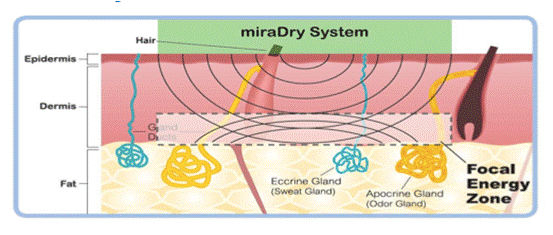 miraDry清新微波 針對狐臭多汗治療的非侵入式 永久性療程