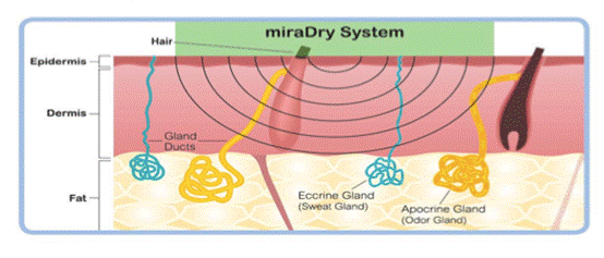 miraDry清新微波 針對狐臭多汗治療的非侵入式 永久性療程