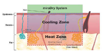 miraDry清新微波 針對狐臭多汗治療的非侵入式 永久性療程
