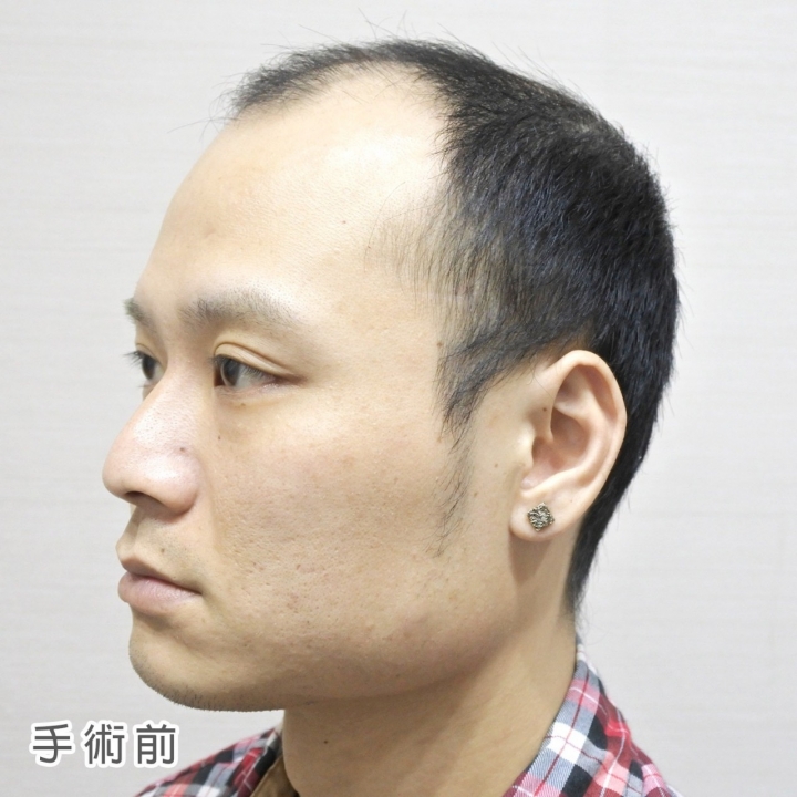 為什麼會選擇去植髮心得分享