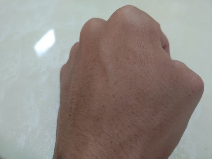 年紀輕輕20歲長出老人斑