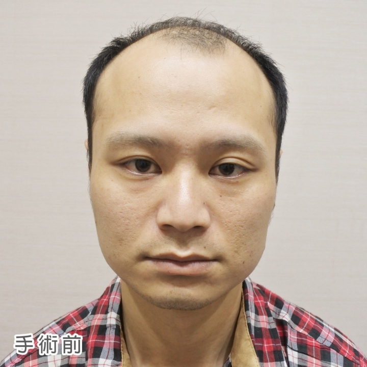 為什麼會選擇去植髮心得分享