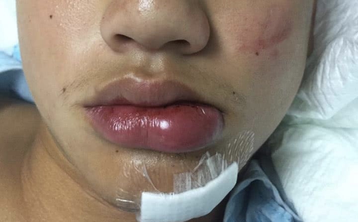 華人學生遭美國同學毒打險失明，凶手用外交特權躲回美國警方無奈