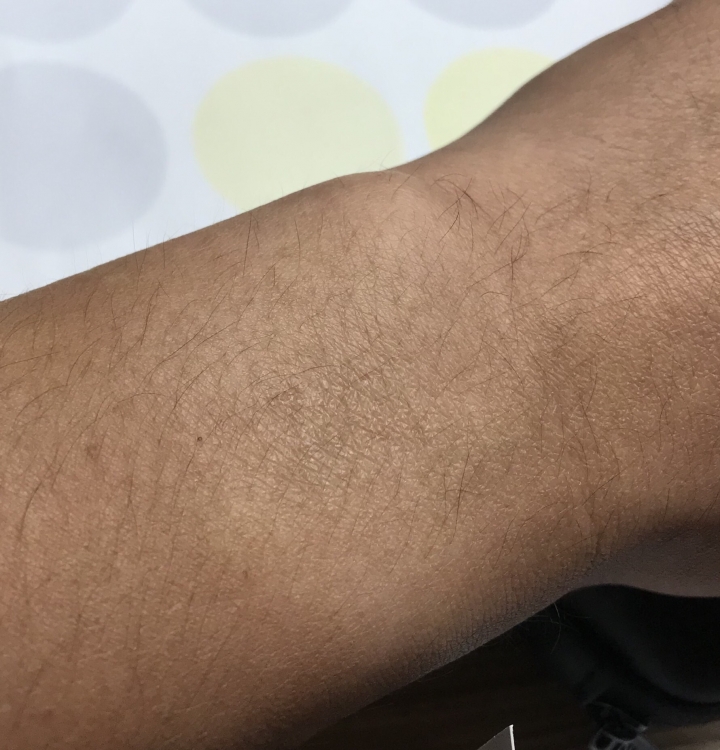 警告：長期戴AW4 ，我被灼傷了？如圖