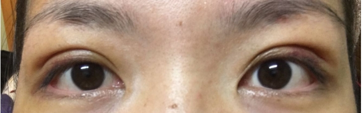 雙眼皮縫好縫滿