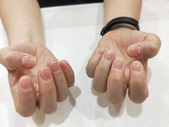 指甲矯正期，真的需要很忍耐？ (分享調整指甲期間的感想和照片 )