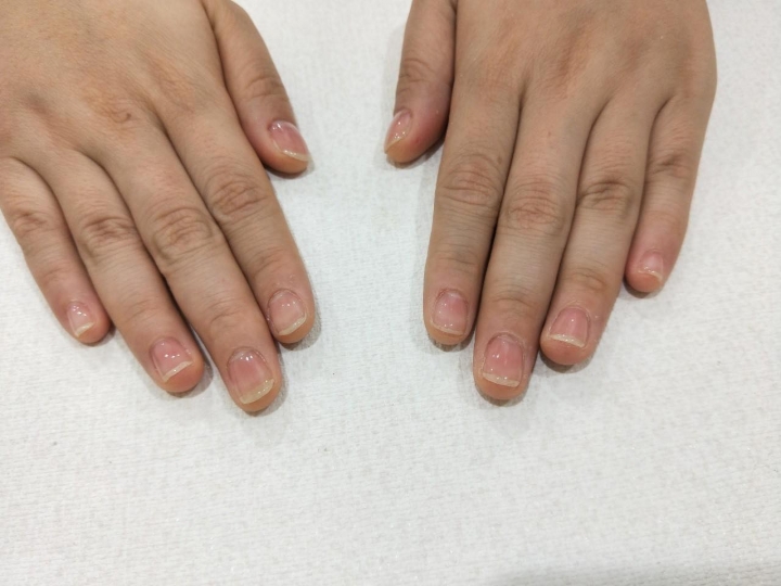 指甲矯正期，真的需要很忍耐？ (分享調整指甲期間的感想和照片 )