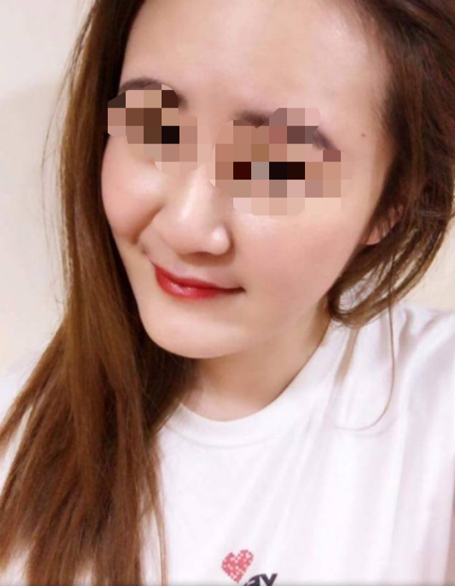 新竹醫美皮秒體驗