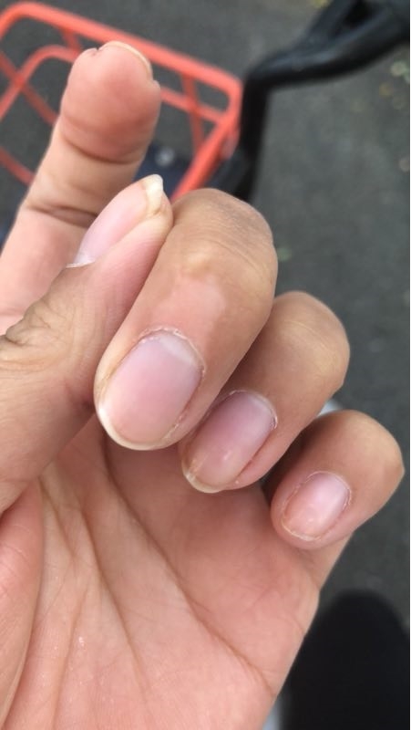 有沒有白斑症的治癒經驗可以分享？