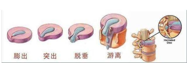 頸椎456(2節)、腰椎45(一節) 背著未爆彈，抉擇是否要開刀
