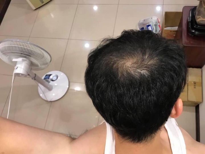 2019.04.26植髮分享