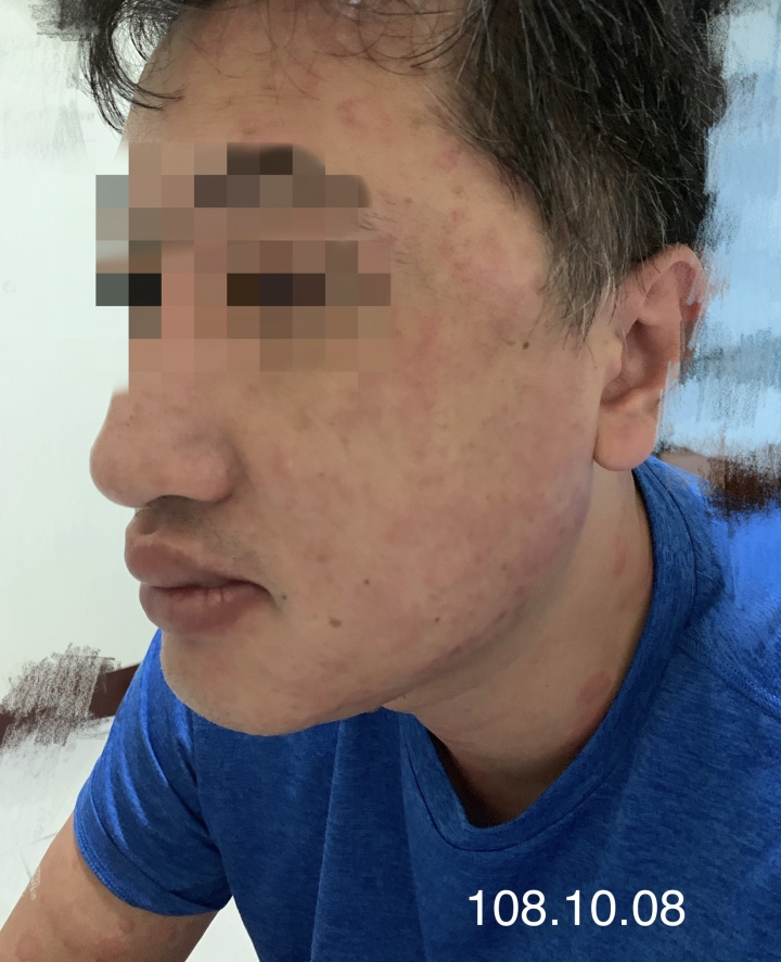 當另一伴有嚴重尋麻疹時...我該如何幫助他