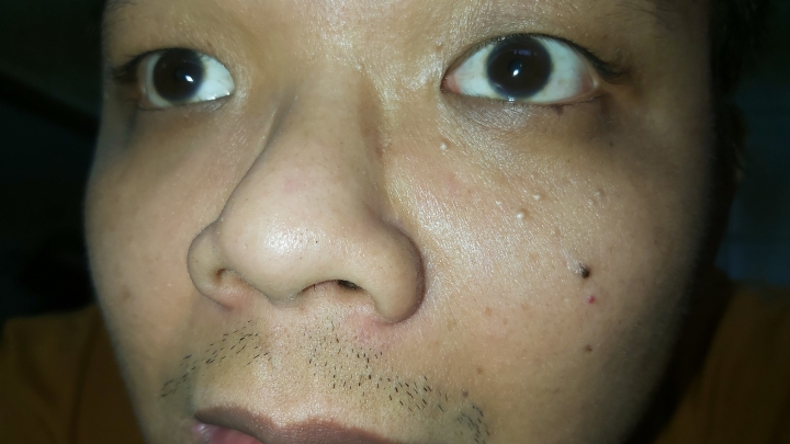 這些一粒一粒白白的是啥?能消除嗎？（圖噁慎入）