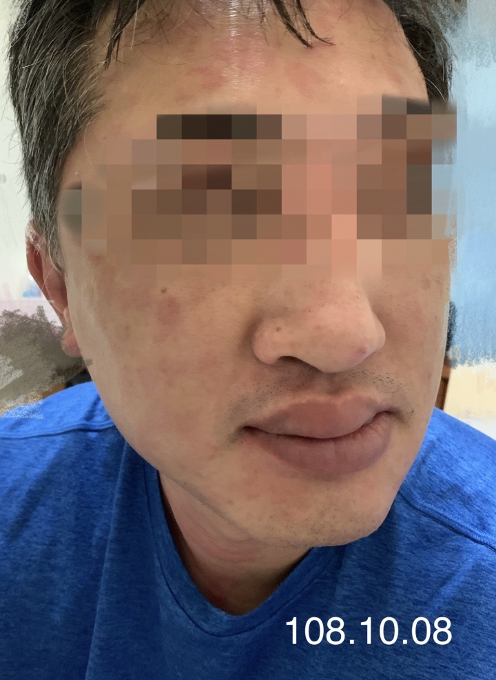 當另一伴有嚴重尋麻疹時...我該如何幫助他
