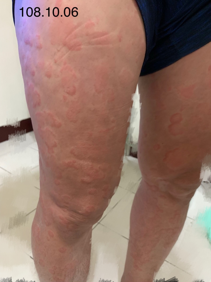 當另一伴有嚴重尋麻疹時...我該如何幫助他