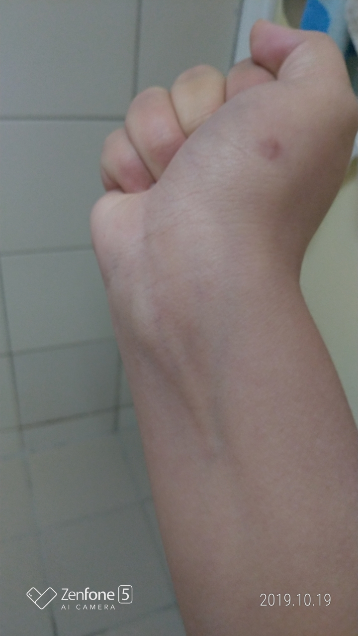 之前物流手腕受傷問題