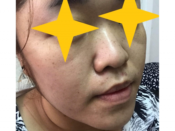 (更新)#高雄 ＃皮秒雷射 picoway 對除斑最有效?
