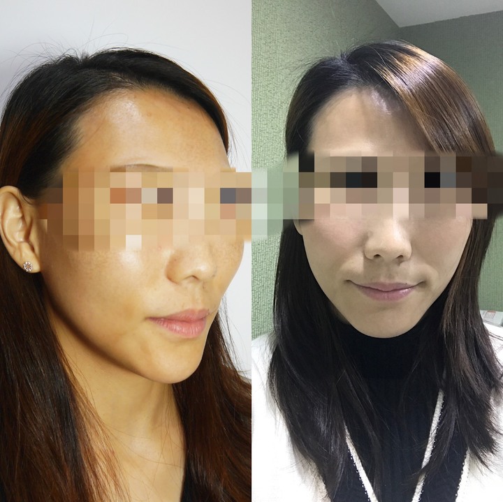 皮秒初體驗分享