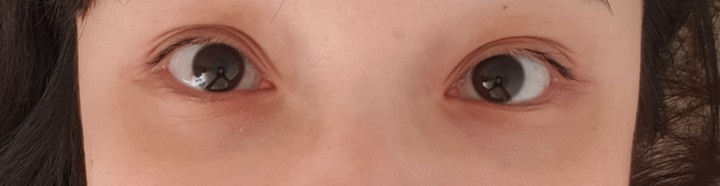 眼窩凹陷，自體脂肪移植推薦