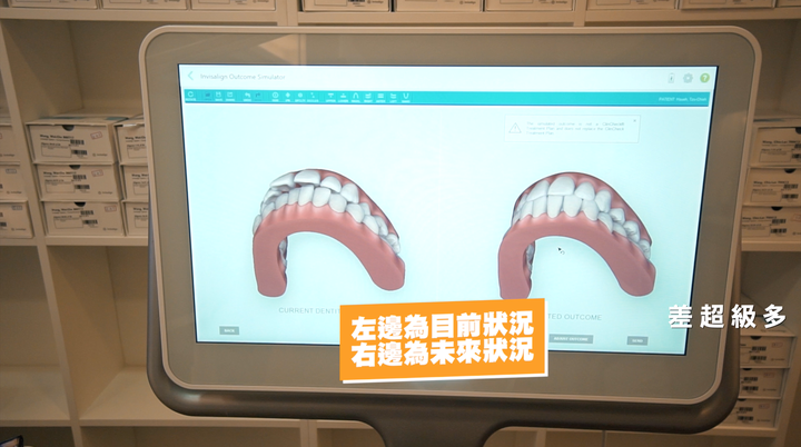 【隱適美牙套開箱】完整記錄矯正前諮詢到開箱拿第一副牙套的過程！