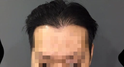 分享老公Ｍ型禿植髮後的喜悅