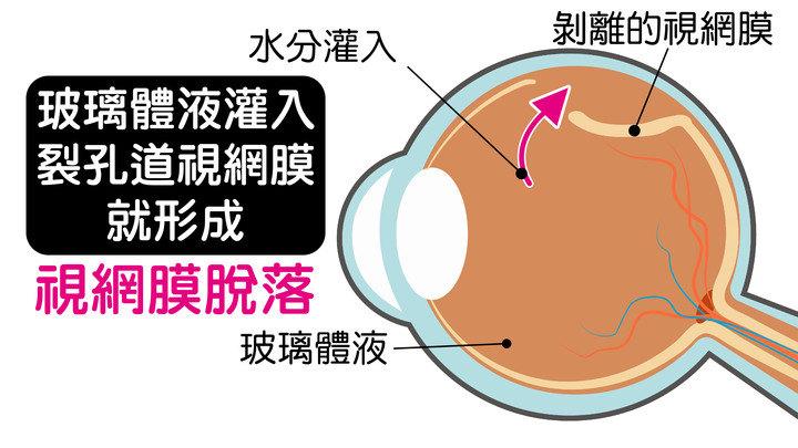 |分享|飛蚊症如何治療與預防