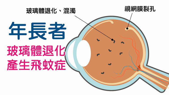|分享|飛蚊症如何治療與預防