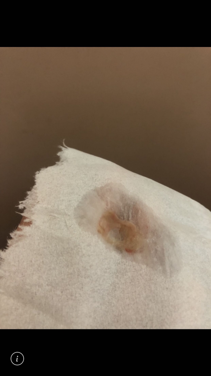 早上有黃褐色血痰，已經兩個多月