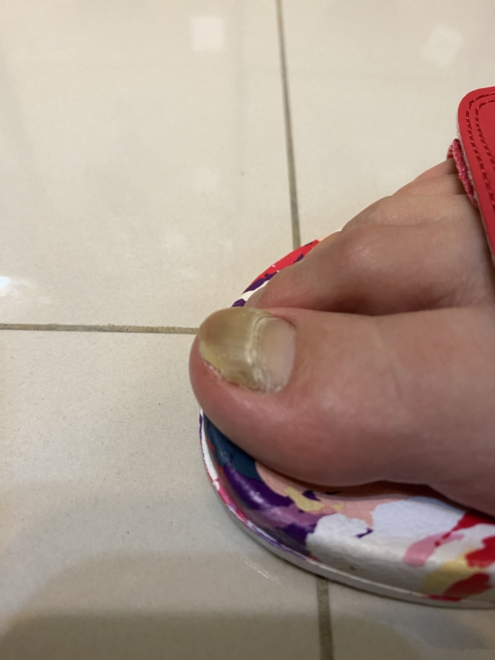 指甲變厚又變薄