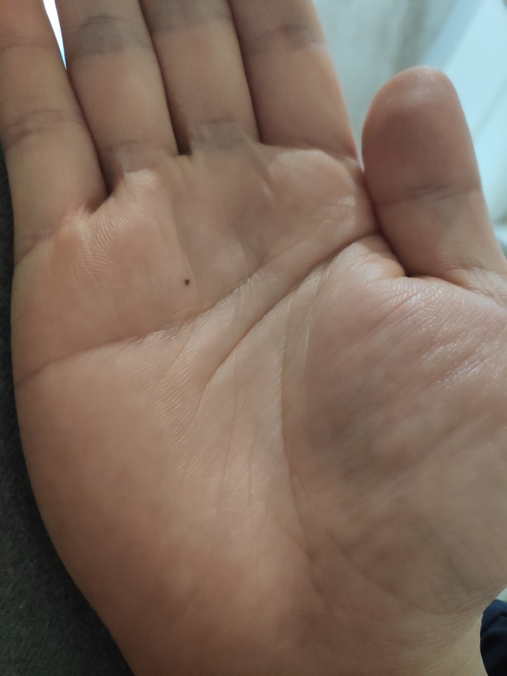有顆神秘痔這一年出現在掌心，有人可解答嗎@@