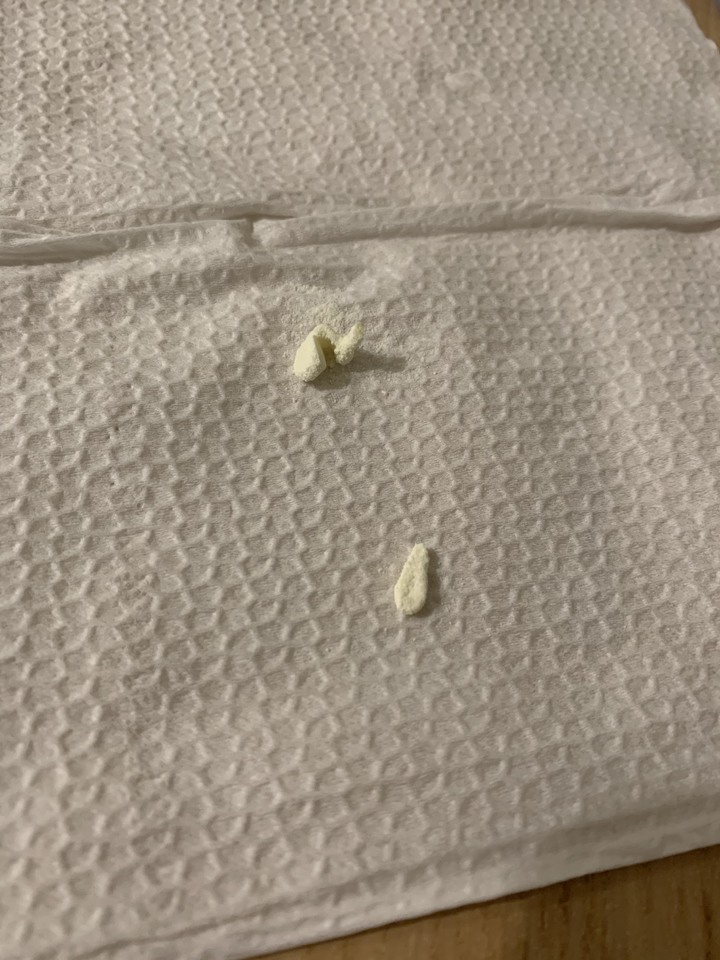 點我看大圖 亞培心美力4號奶粉罐內發現異物結塊
